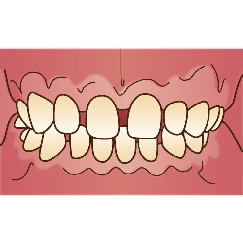悪い歯並びって何 隙間 空隙歯列 について