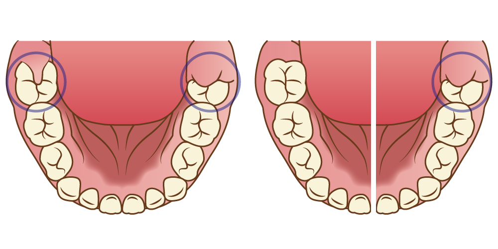 6 歳 臼歯 生え 始め 痛い